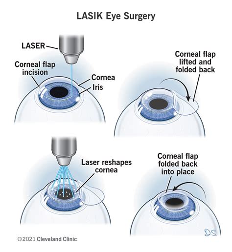 LASIK Eye Surgery