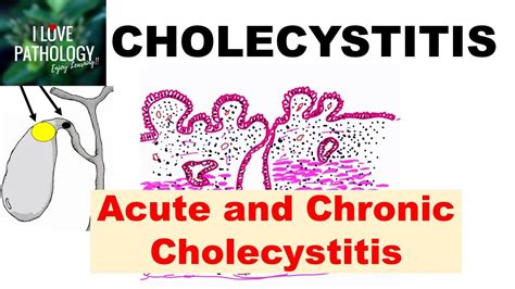 CHOLECYSTITIS: Acute and Chronic. Pathology and Complications - YouTube