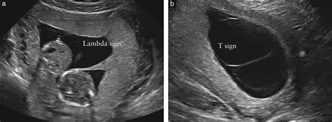 Isuog Practice Guidelines Role Of Ultrasound In Twin Pregnancy | Free Nude Porn Photos