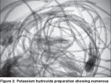 Top 111 + Eruptive vellus hair cysts cause - polarrunningexpeditions