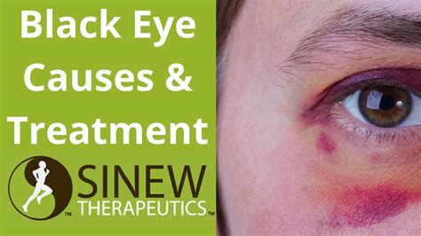 Black Eye Causes and Treatment - YouTube