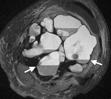 Giant Cell Tumor Mri