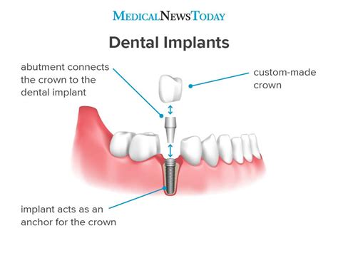 What are dental implants? Types, procedures, and more