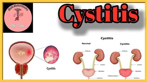 Cystitis| cause | symptoms| pathophysiology | Management #cystitis ...