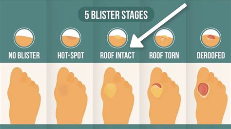 How To Treat A Blister Correctly (First, Look At Your Blister Roof ...