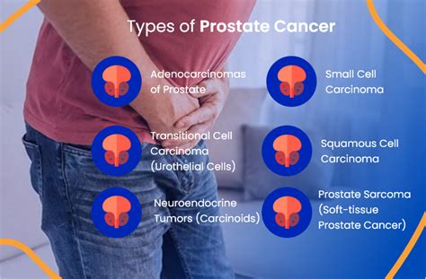 Prostate Cancer Treatment: Everything You Need To Know | ACTC