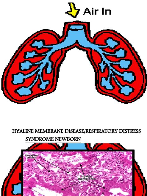 HYALINE MEMBRANE DISEASE-1 | Respiratory System | Medical Specialties