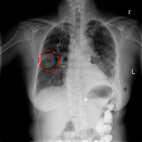 NIH releases 100K chest X-ray images for deep learning - Offtopic - JuliaLang