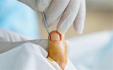 Ingrown Toenails - Straits Podiatry