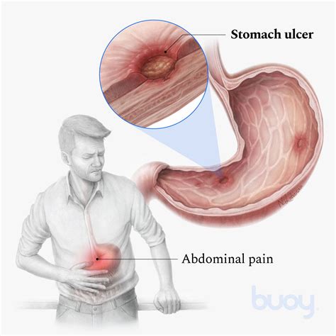 How do you know if you have a stomach ulcer? - 27F Chilean Way