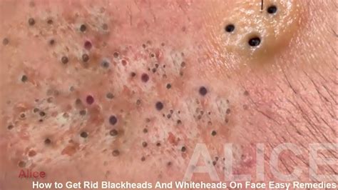 How to Get Rid Blackheads And Whiteheads On Face Easy Remedies - YouTube