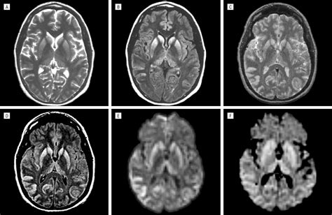 Sporadic Creutzfeldt-Jakob Disease Mimicking Variant Creutzfeldt-Jakob Disease. | Dementia and ...