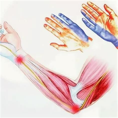 Ulnar canal syndrome - preverehealth.com