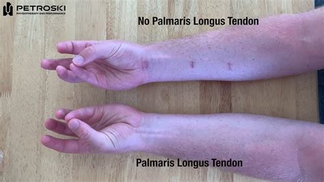 Palmaris Longus Test - YouTube