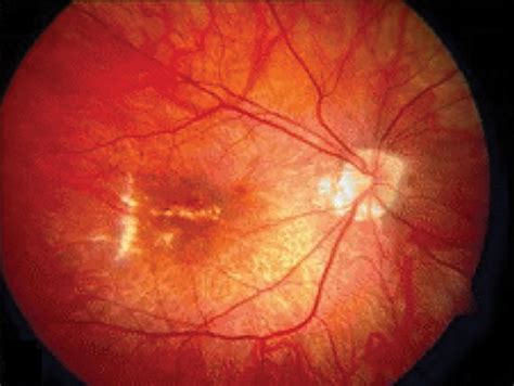 Multifocal Choroiditis with Panuveitis | Ento Key