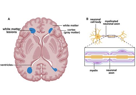 What is the link between white matter lesions and neurodegeneration?