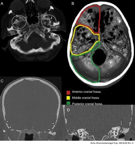 Arachnoid Granulations as Cause of Tegmen Tympani Defects | Acta Otorrinolaringológica Española