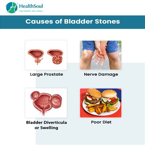 Bladder Stones: Symptoms and Treatment – Healthsoul