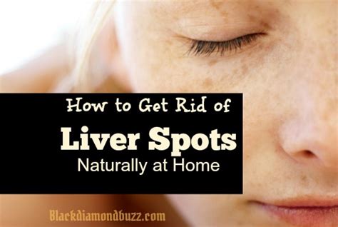 11 Best Way on How to Get Rid of Liver Spots Naturally at Home