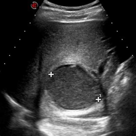 Liver Abscess Radiology