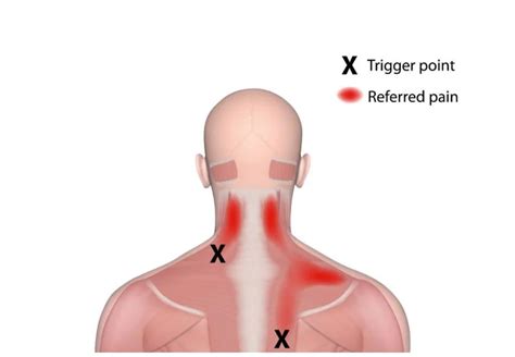 WHAT ARE YOU REFERRING TO?? - Referred Pain Explained