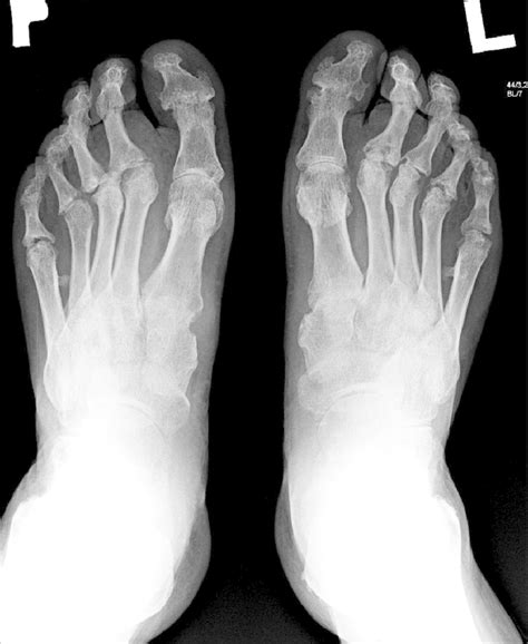 Top 91+ Wallpaper Pictures Of Psoriatic Arthritis In Feet Stunning 09/2023
