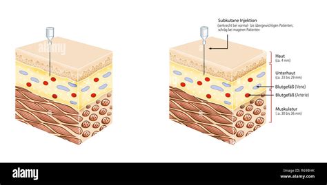 Subcutaneous Abscess Treatment