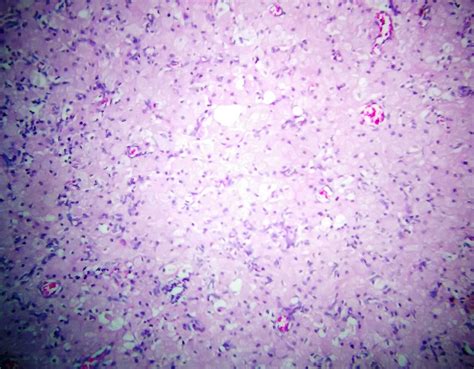 Pathology Outlines - Congenital epulis of newborn