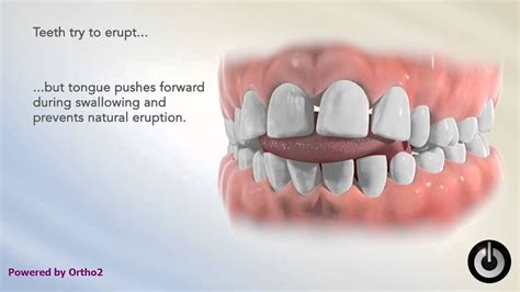 tongue thrust treatment for adults - jacobos-mezquita