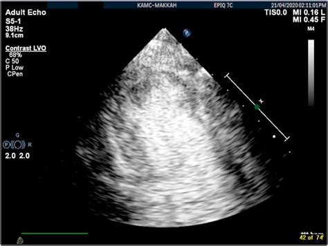 LV Thrombus demonstrated by Echocardiography with IV contrast agents. | Download Scientific Diagram