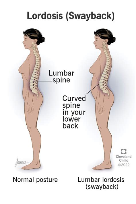 Loss Of Lumbar Lordosis Exercises