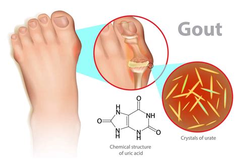 Gout Treatment & Symptoms Podiatrist near me- Beaver Valley Foot Clinic