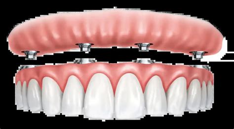 All on 4 Dental Implants – Full Set of Replacement Teeth - Zenith ...