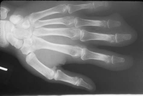 Trauma: Multiple finger degloving treated with medial cross arm flap and temporary syndactyly