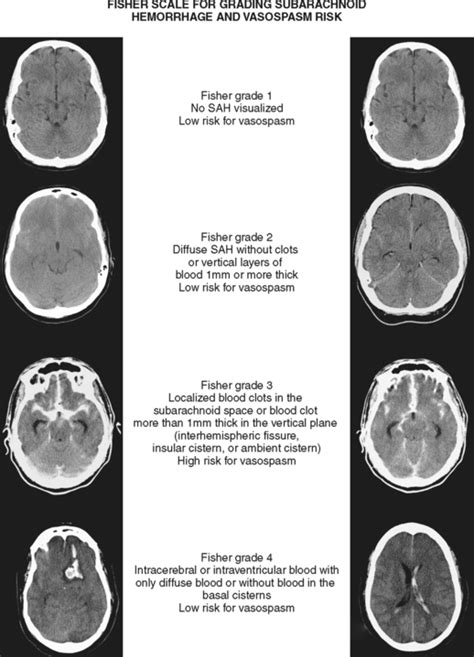 Subarachnoid Hemorrhage | Clinical Gate