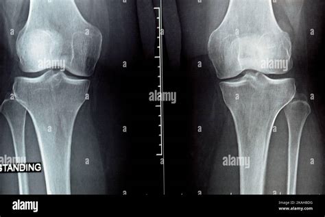 plain x ray on knee joint showing joint space narrowing and Subchondral Sclerosis on medial ...