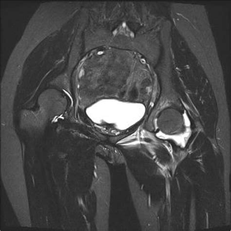 Septic arthritis caused by Brucella melitensis in urban Shenzhen, China ...