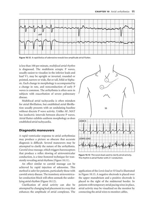 Ecg interpretation