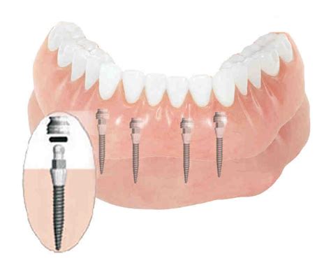 How much does it cost for bone grafting for dental implants - Dental ...