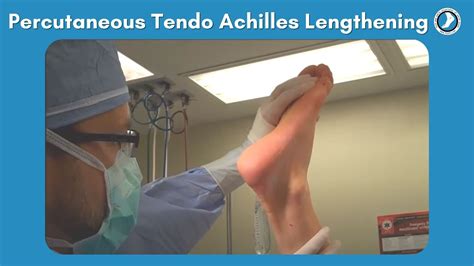 Achilles Tendon Lengthening Surgery | atelier-yuwa.ciao.jp