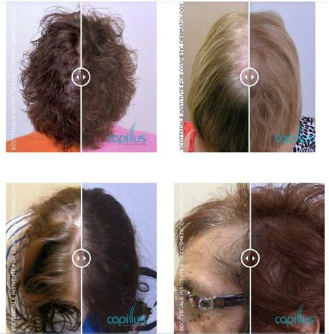 Women Before and After Capillus Hair Loss Treatment - Willow Health and Aesthetics