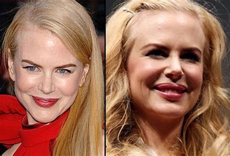 Nicole Kidman before and after plastic surgery facelift, botox, lip ...