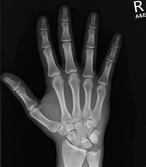 Docs and Radiologists does this look like a fracture to you? - AR15.COM