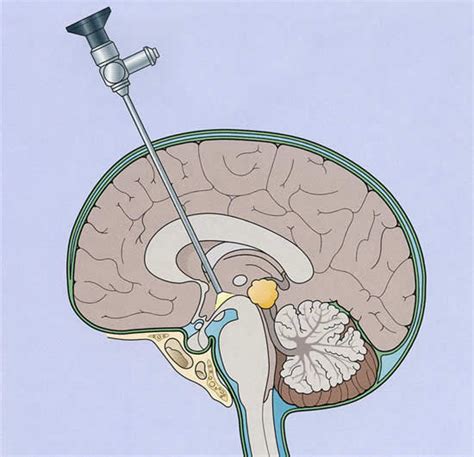 Intracranial Endoscopy System Fiber-Optic Biopsy Needle Minimizes ...