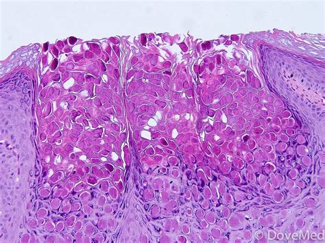 Molluscum Contagiosum Virus