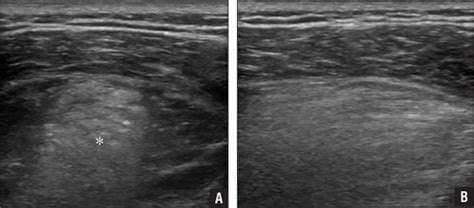 Lipoma Ultrasound Treatment - Infoupdate.org