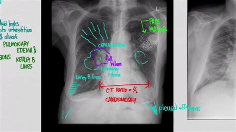 Chf with pulmonary edema