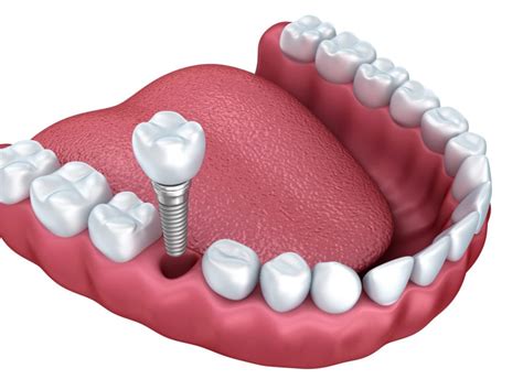 Types of Dental Implants Claremont CA | Teeth Implants