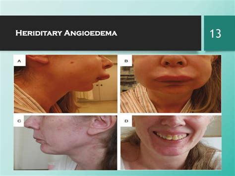 Hereditary angioedema | PPT