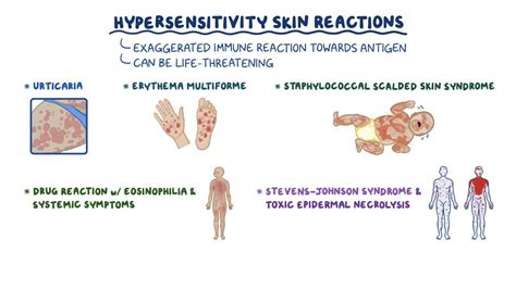 Hypersensitivity skin reactions: Clinical practice - Osmosis